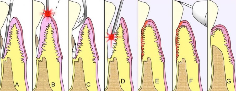 Illustration showing the seven phases of laser therapy.